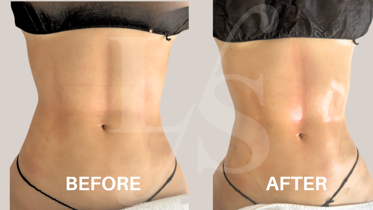 Body sculpting result 1