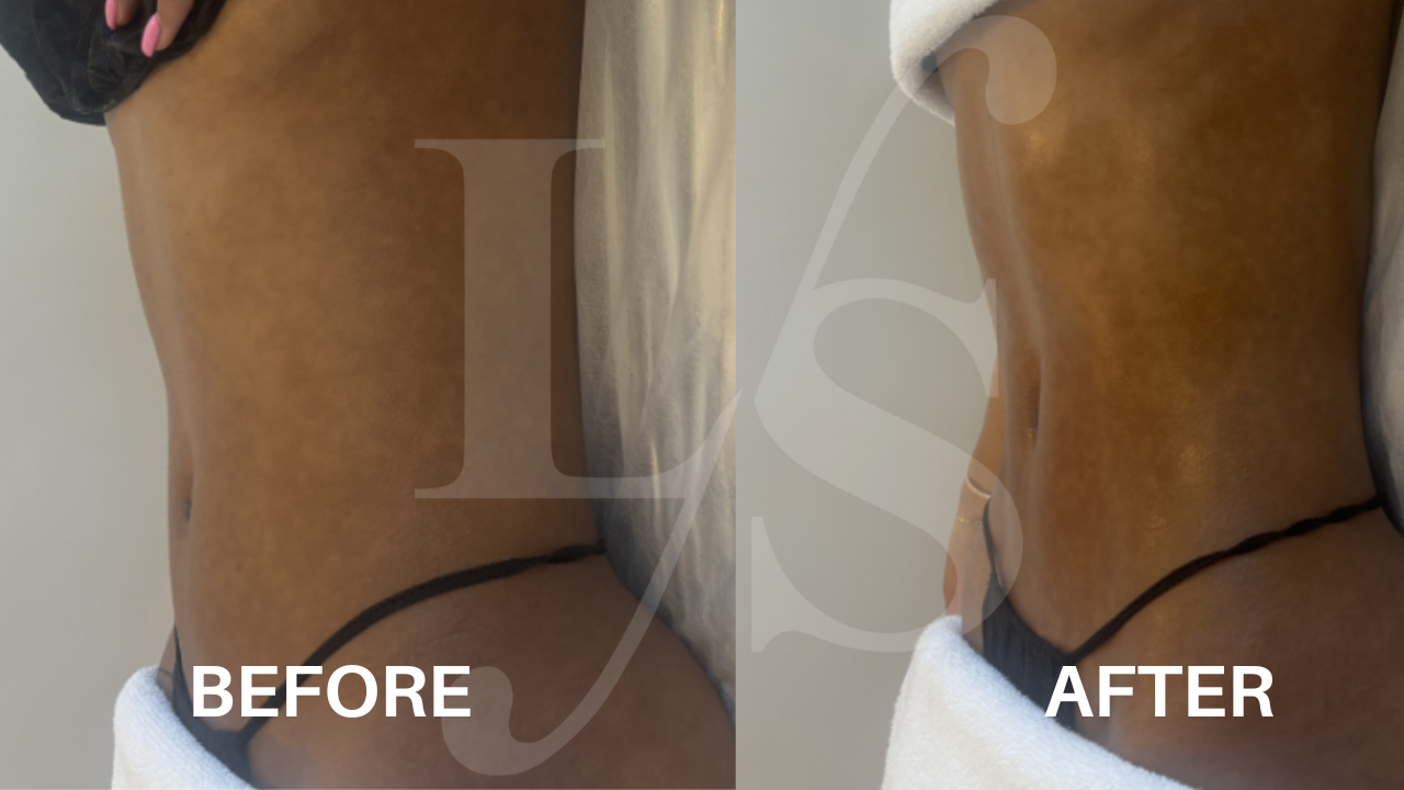 Body sculpting result 10