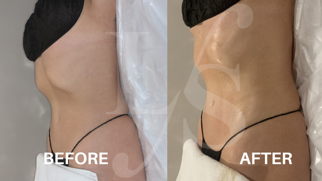 Body sculpting result 11