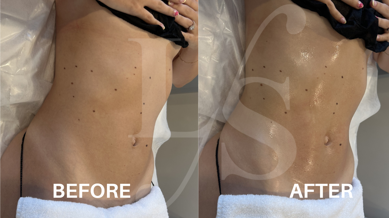 Body sculpting result 12