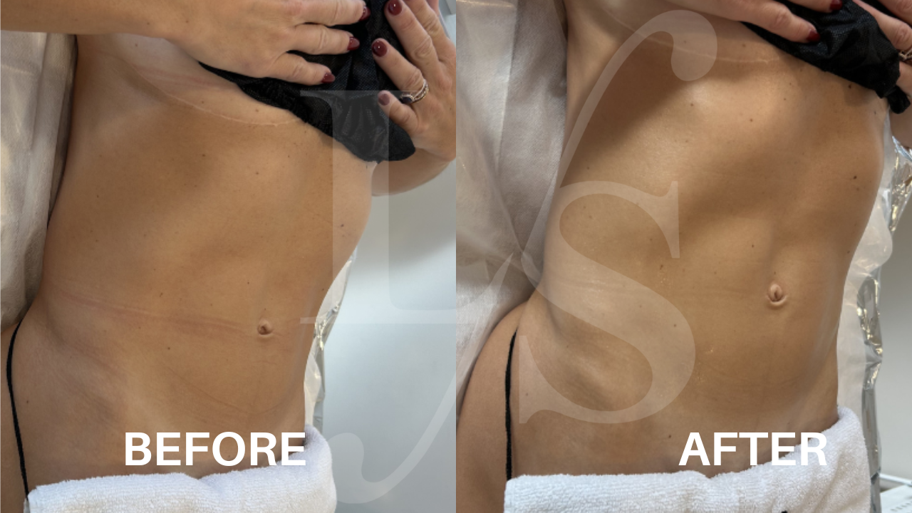 Body sculpting result 13