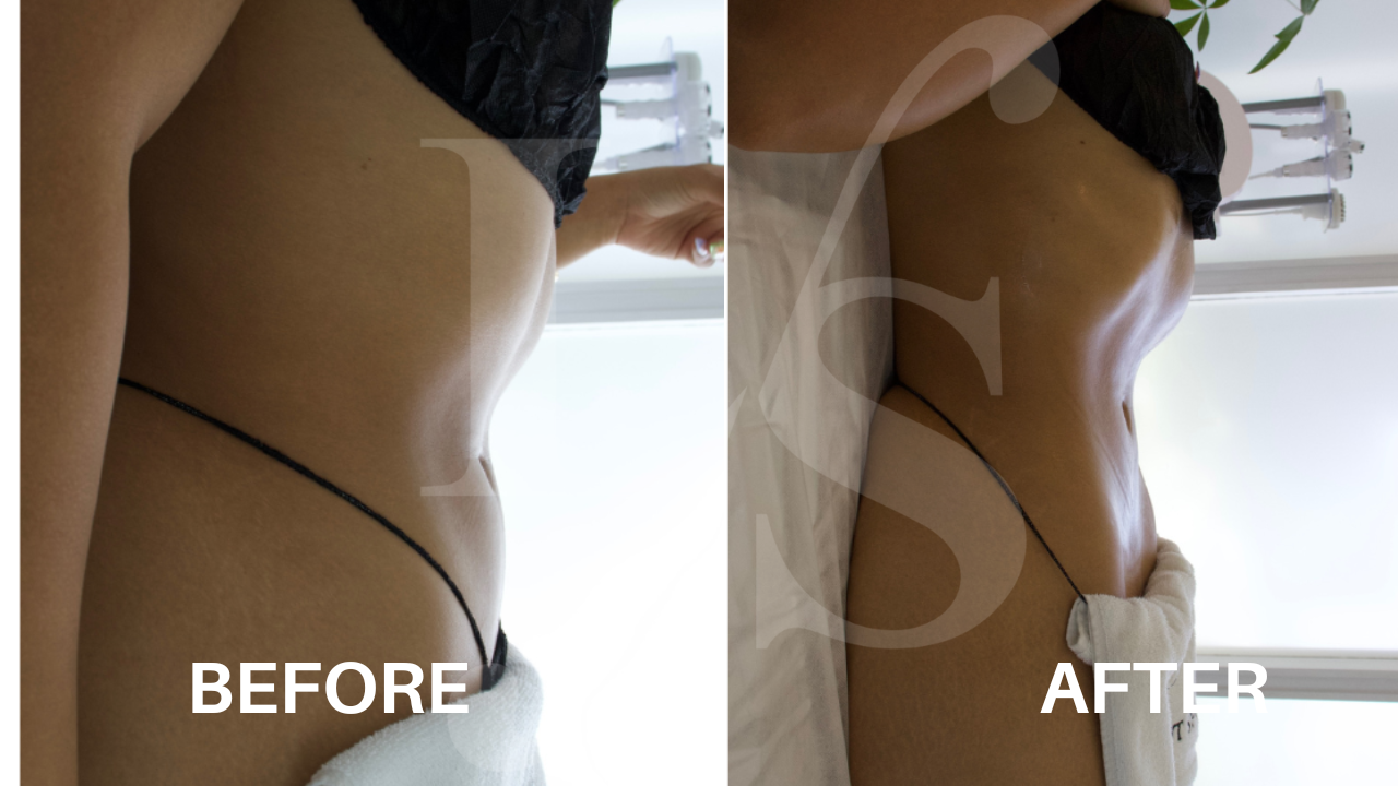 Body sculpting result 14