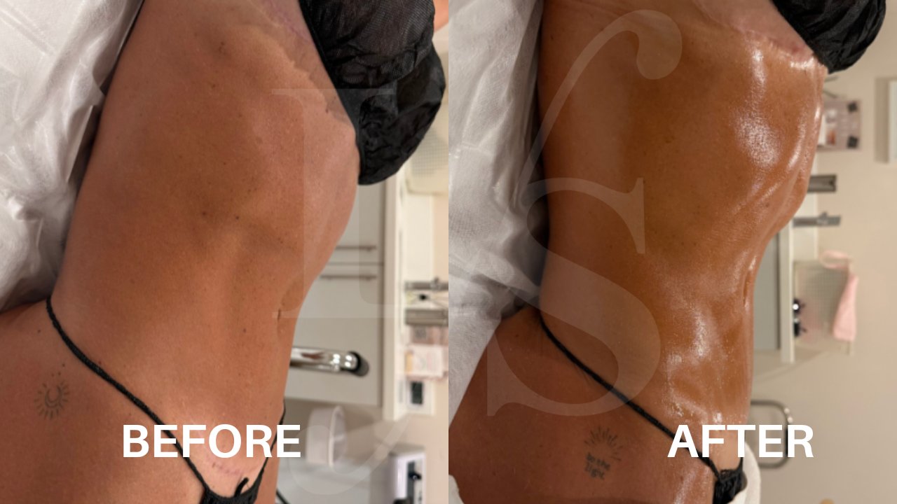 Body sculpting result 15