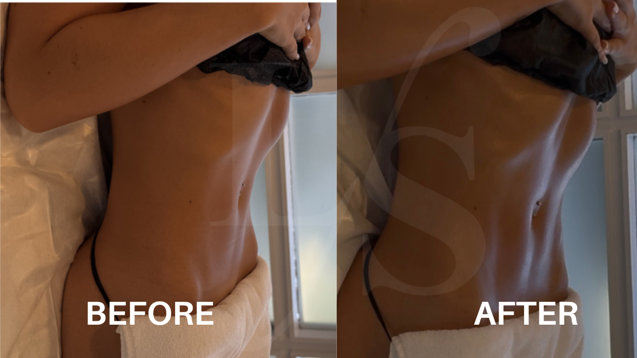 Body sculpting result 16