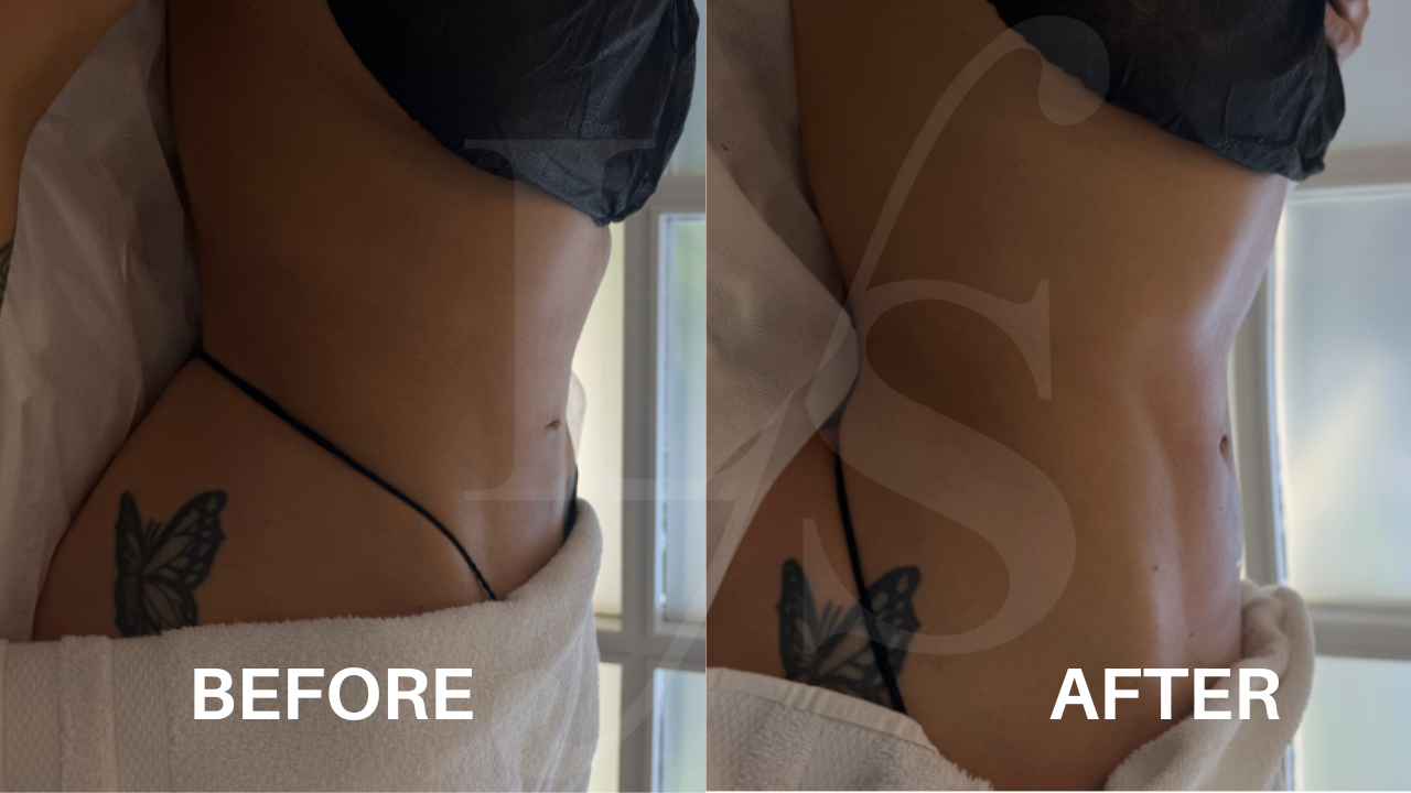 Body sculpting result 17