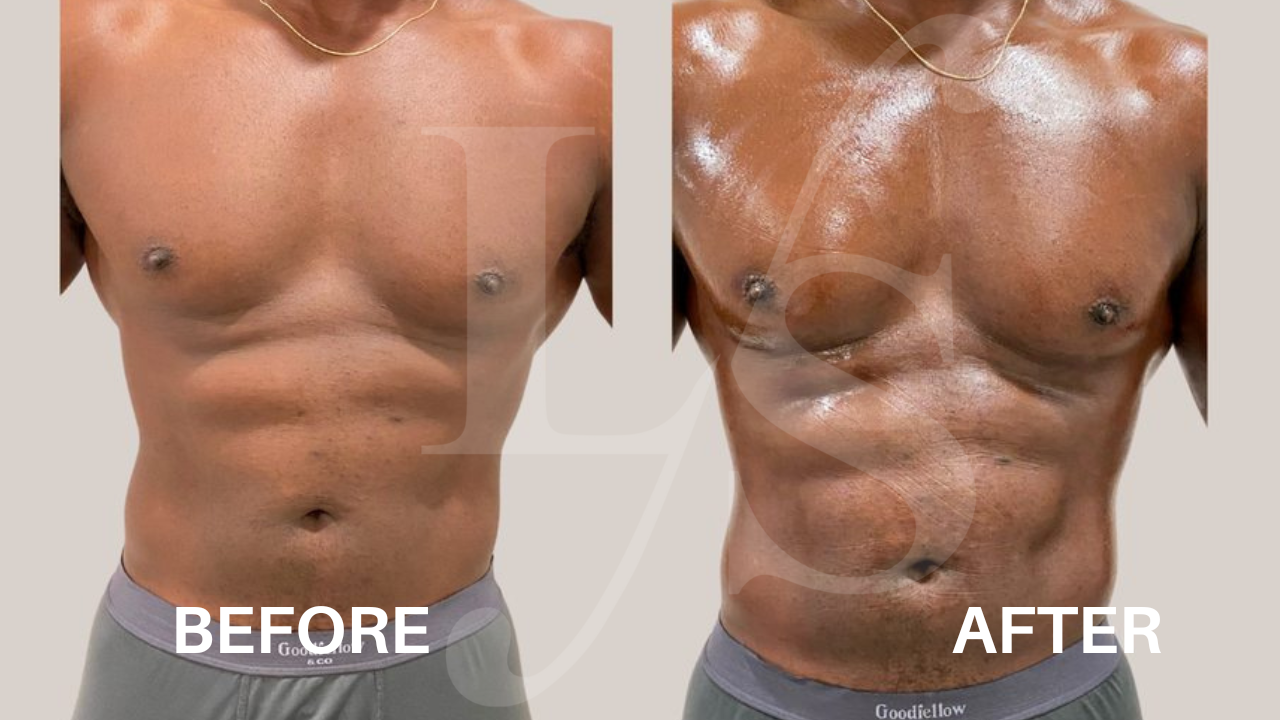 Body sculpting result 18