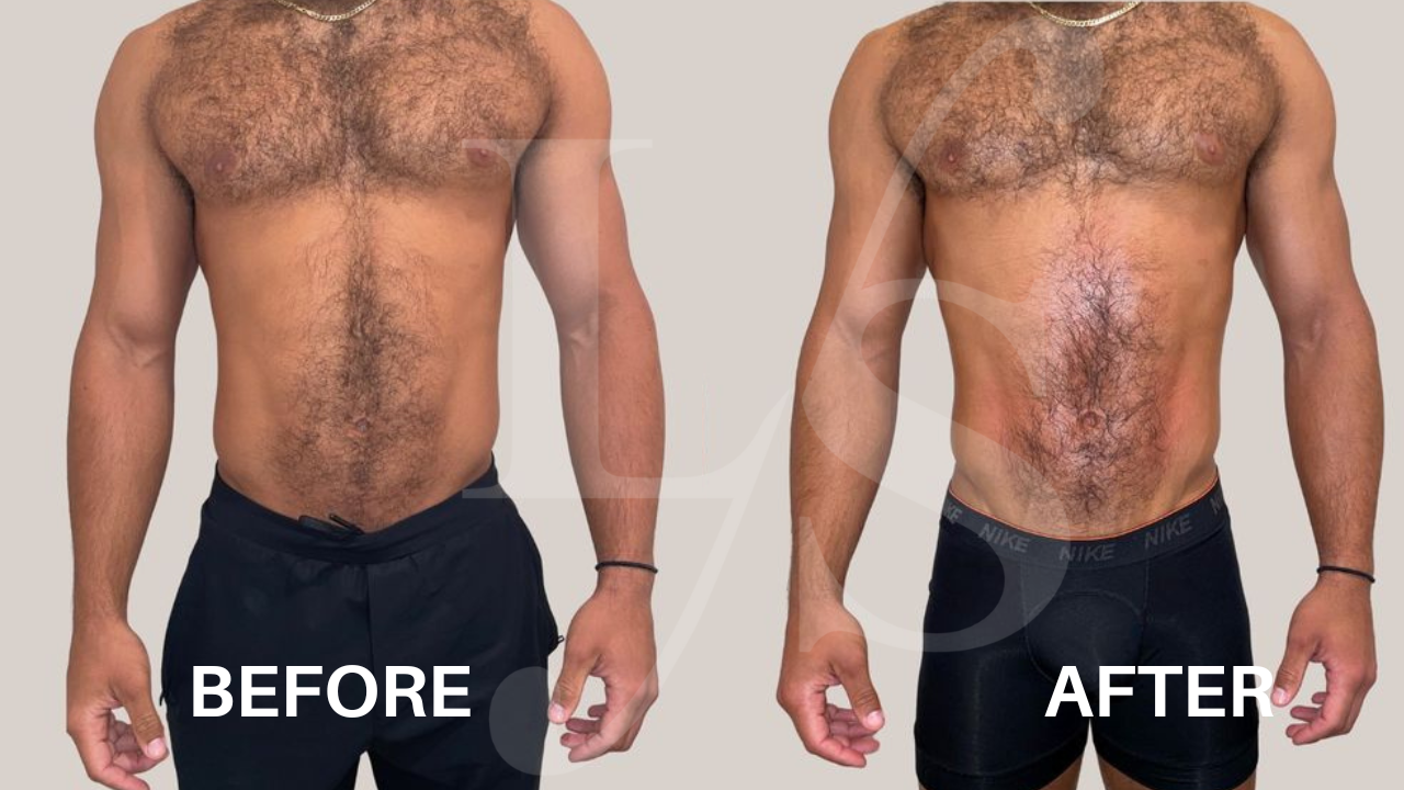 Body sculpting result 19