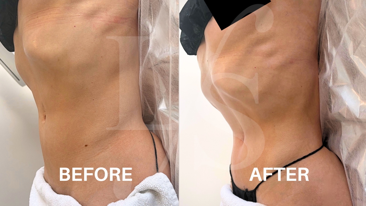 Body sculpting result 2