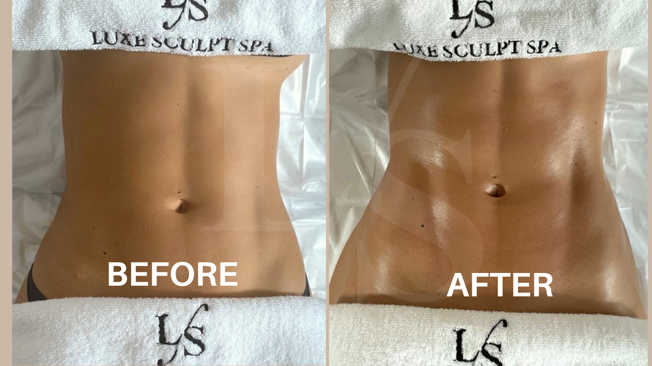 Body sculpting result 20
