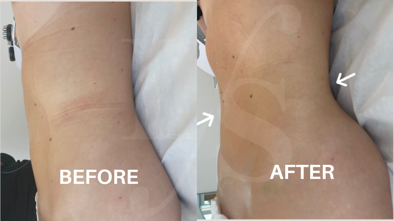 Body sculpting result 21