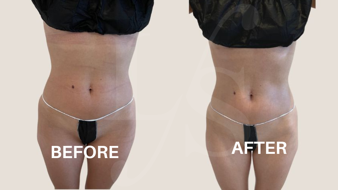 Body sculpting result 22