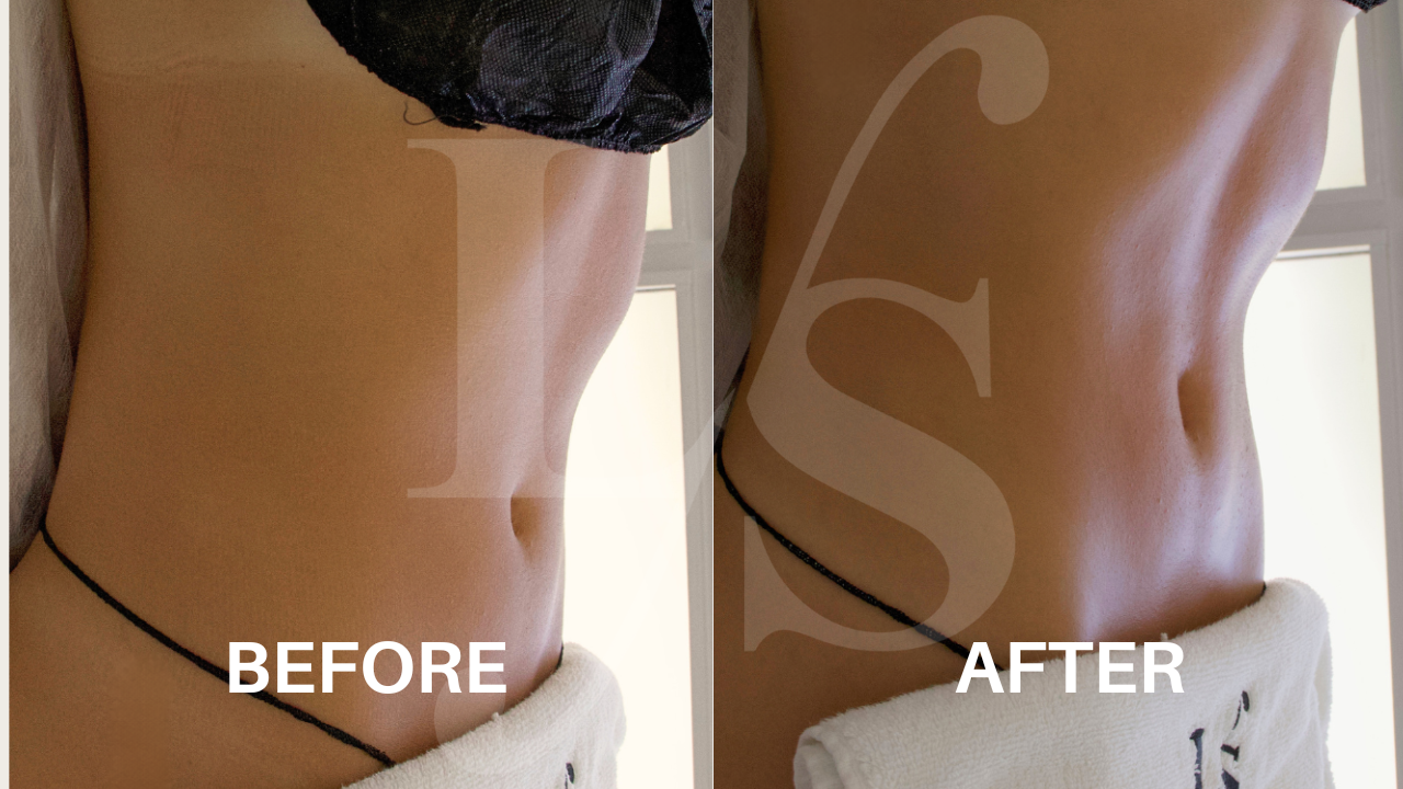 Body sculpting result 3