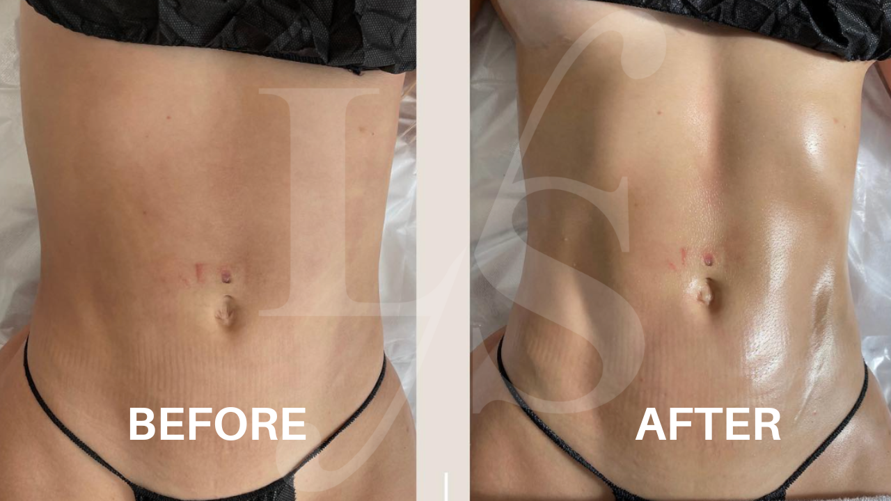Body sculpting result 4