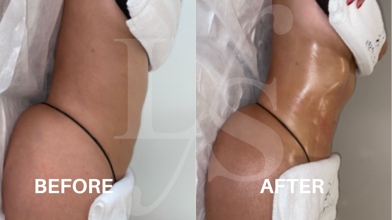 Body sculpting result 5