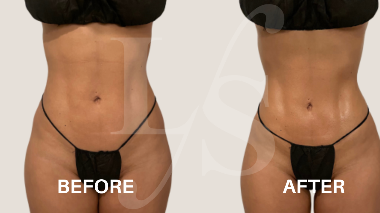 Body sculpting result 6