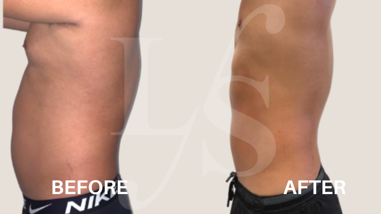 Body sculpting result 7