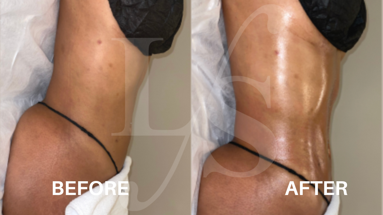 Body sculpting result 8