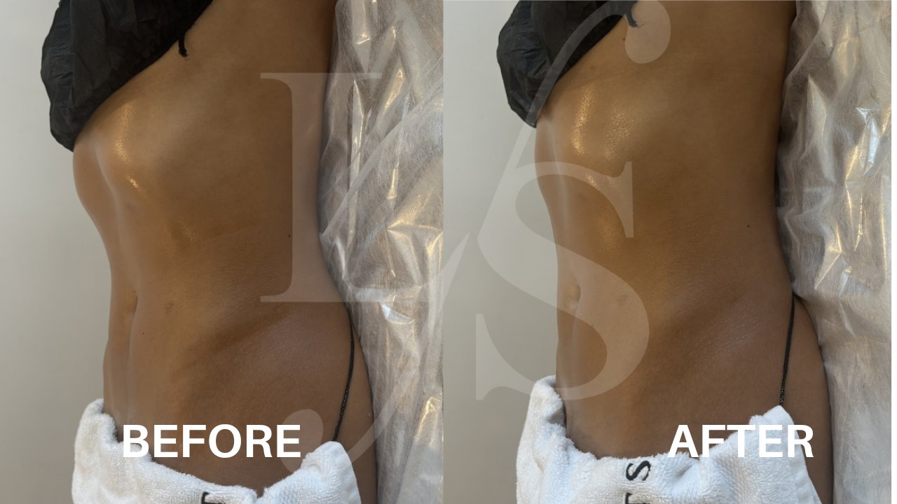 Body sculpting result 9